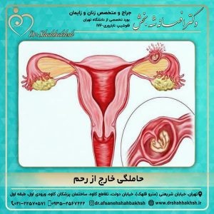 حاملگی خارج از رحم 