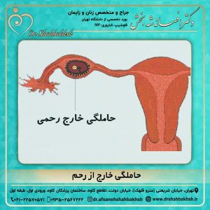 حاملگی خارج از رحم