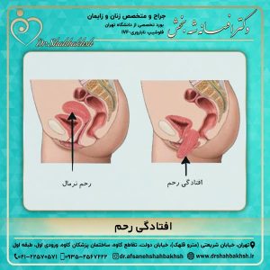 افتادگی رحم