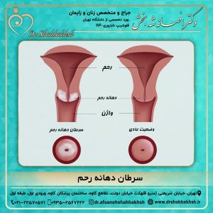 سرطان دهانه رحم