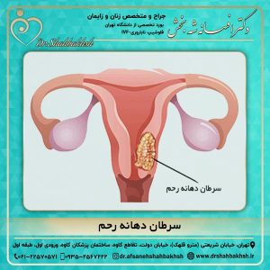 سرطان دهانه رحم