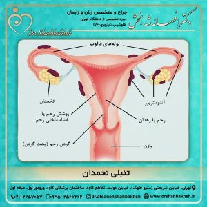تنبلی تخمدان
