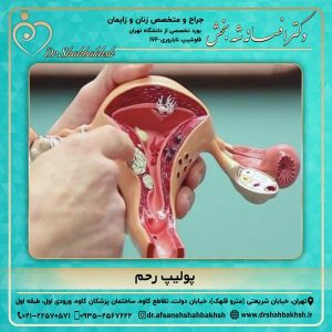پولیپ رحم