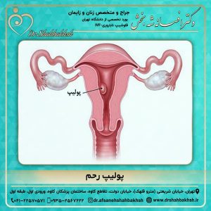 پولیپ رحم