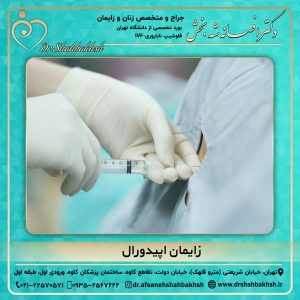 زایمان اپیدورال