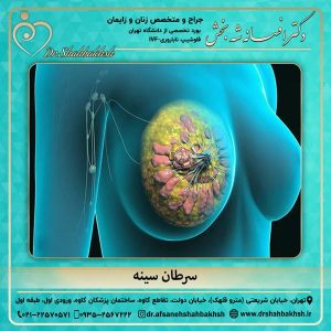 سرطان سینه