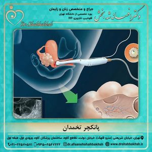 پانکچر تخمدان