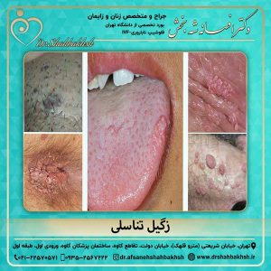 زگیل تناسلی