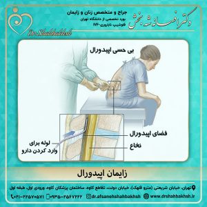 زایمان اپیدورال