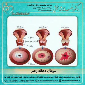 سرطان دهانه رحم