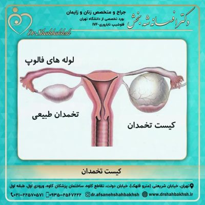کیست تخمدان - دکتر شه بخش