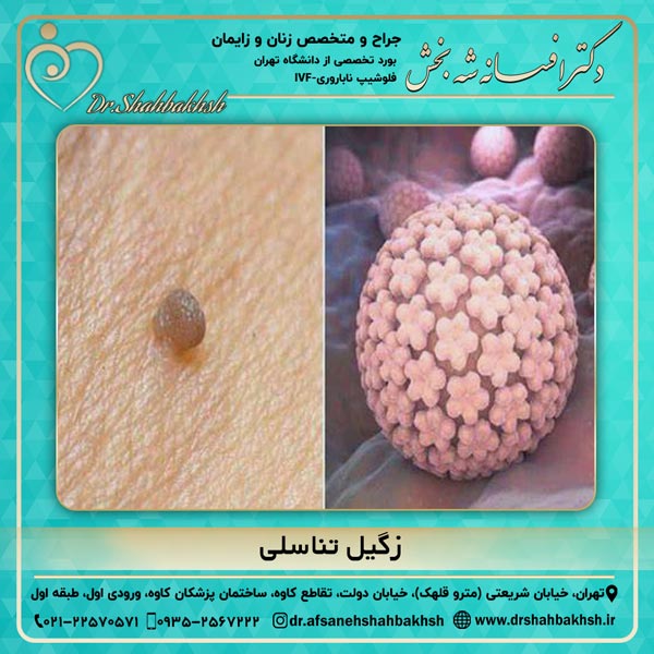 زگیل تناسلی