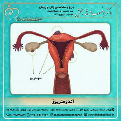 آندومتریوز - دکتر شه بخش
