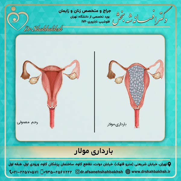بارداری مولار