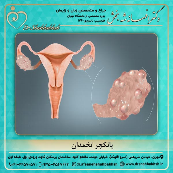 پانکچر تخمدان