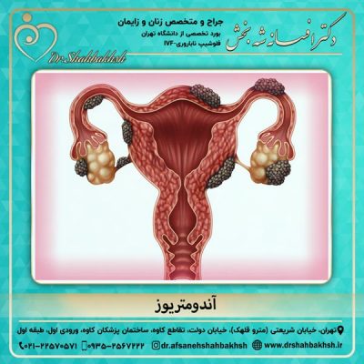 آندومتریوز - دکتر شه بخش