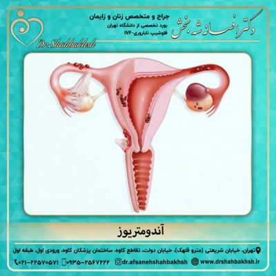 آندومتریوز - دکتر شه بخش